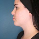 Chin Lipo Before & After Patient #773