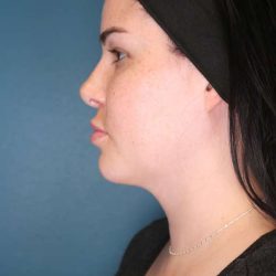 Chin Lipo Before & After Patient #773