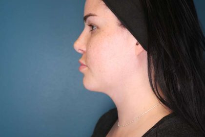 Chin Lipo Before & After Patient #773