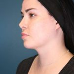 Chin Lipo Before & After Patient #773