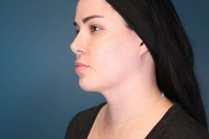 Chin Lipo Before & After Patient #773