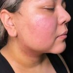 Chin Lipo Before & After Patient #779