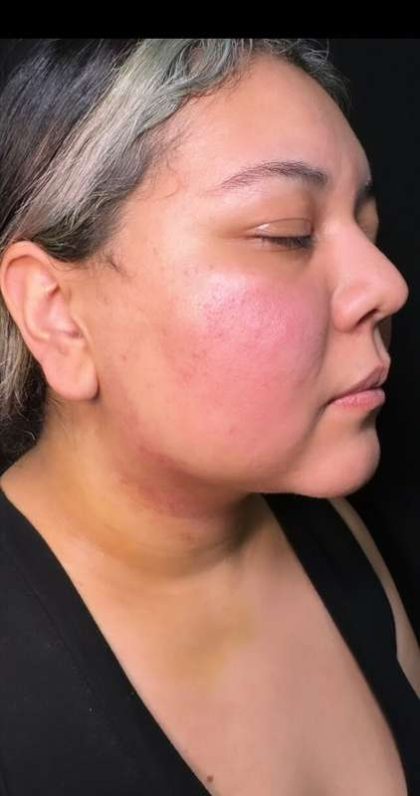 Chin Lipo Before & After Patient #779