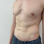 Liposuction Before & After Patient #838
