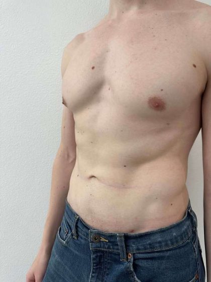 Liposuction Before & After Patient #838
