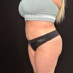 Tummy Tuck Before & After Patient #877