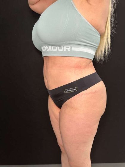 Tummy Tuck Before & After Patient #877