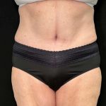 Tummy Tuck Before & After Patient #880
