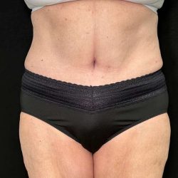 Tummy Tuck Before & After Patient #880