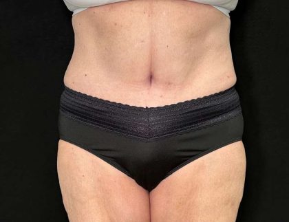 Tummy Tuck Before & After Patient #880