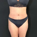 Tummy Tuck Before & After Patient #886