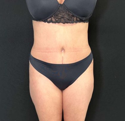 Tummy Tuck Before & After Patient #886
