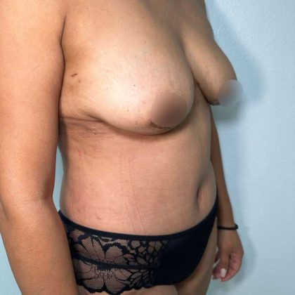 Tummy Tuck Before & After Patient #912