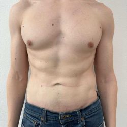 Liposuction Before & After Patient #838