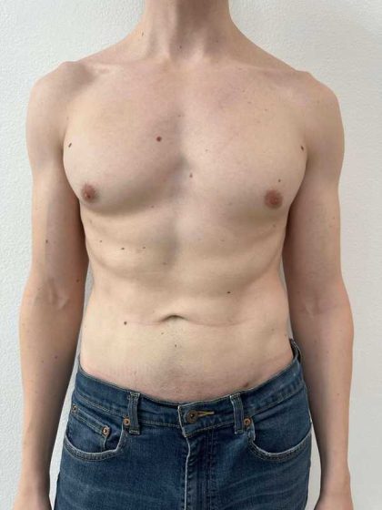Liposuction Before & After Patient #838