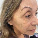 Botox Before & After Patient #552