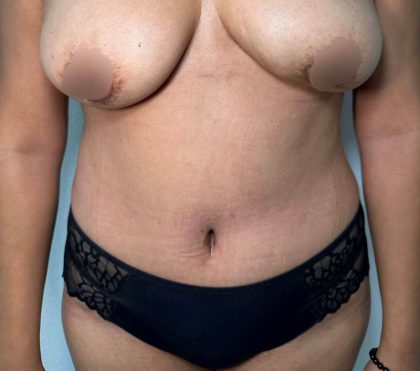 Tummy Tuck Before & After Patient #912