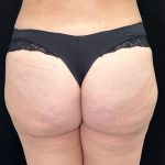 Brazilian Butt Lift Before & After Patient #557