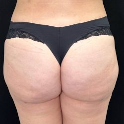 Brazilian Butt Lift Before & After Patient #557