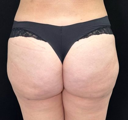 Brazilian Butt Lift Before & After Patient #557