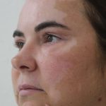 Eyelid Lift Before & After Patient #632