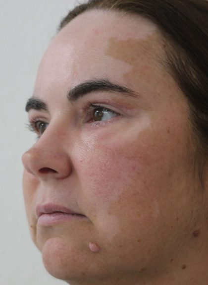 Eyelid Lift Before & After Patient #632