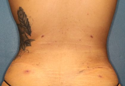 Liposuction Before & After Patient #792