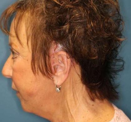 Facelift Before & After Patient #596