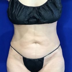 Liposuction Before & After Patient #849