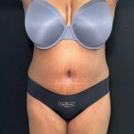 Tummy Tuck Before & After Patient #891