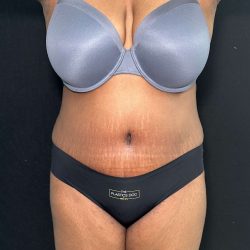 Tummy Tuck Before & After Patient #891