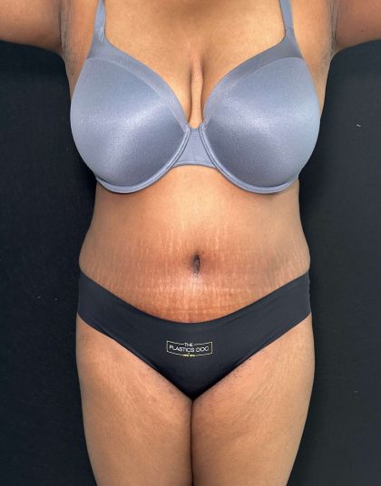 Tummy Tuck Before & After Patient #891