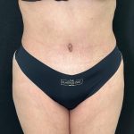 Tummy Tuck Before & After Patient #896