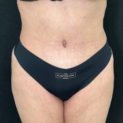 Tummy Tuck Before & After Patient #896