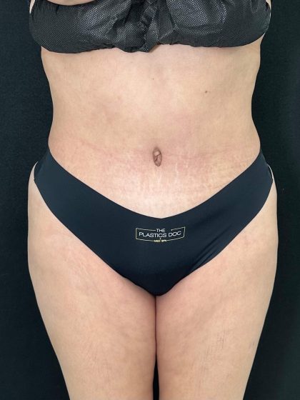 Tummy Tuck Before & After Patient #896