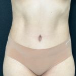 Tummy Tuck Before & After Patient #907