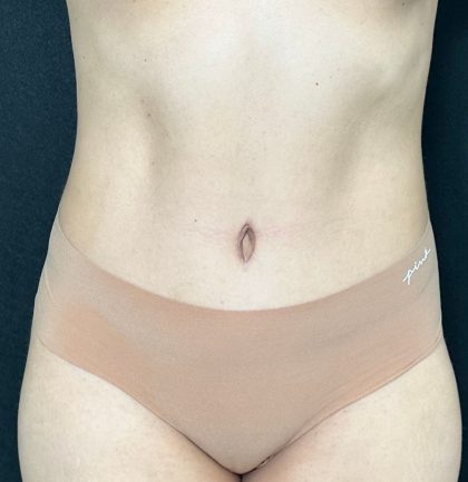 Tummy Tuck Before & After Patient #907