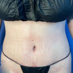 Tummy Tuck Before & After Patient #928