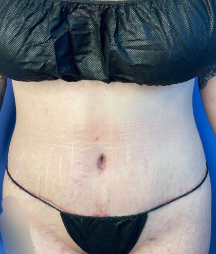 Tummy Tuck Before & After Patient #928