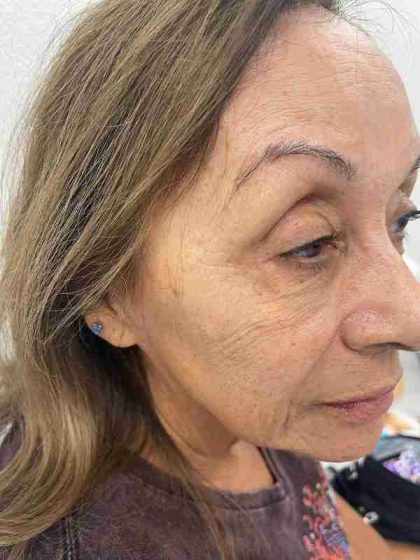Botox Before & After Patient #552