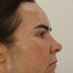 Eyelid Lift Before & After Patient #632