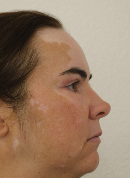 Eyelid Lift Before & After Patient #632