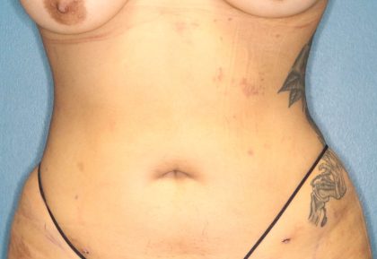 Liposuction Before & After Patient #792