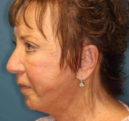 Facelift Before & After Patient #596