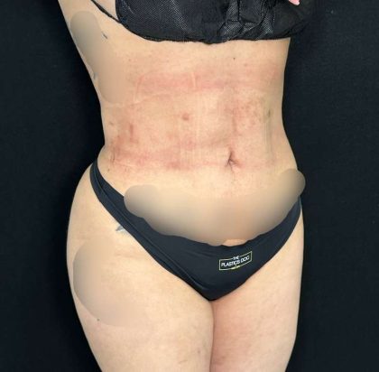 Liposuction Before & After Patient #761