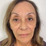 Botox Before & After Patient #552