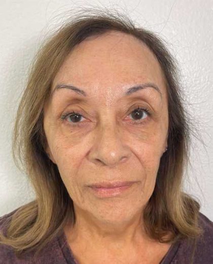 Botox Before & After Patient #552