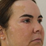 Eyelid Lift Before & After Patient #632