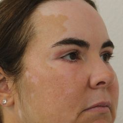 Eyelid Lift Before & After Patient #632