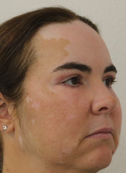 Eyelid Lift Before & After Patient #632